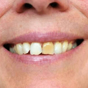 почему темнеют зубы